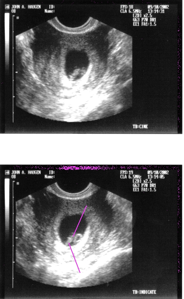 MarkedSonogram7Weeks.jpg (400706 bytes)